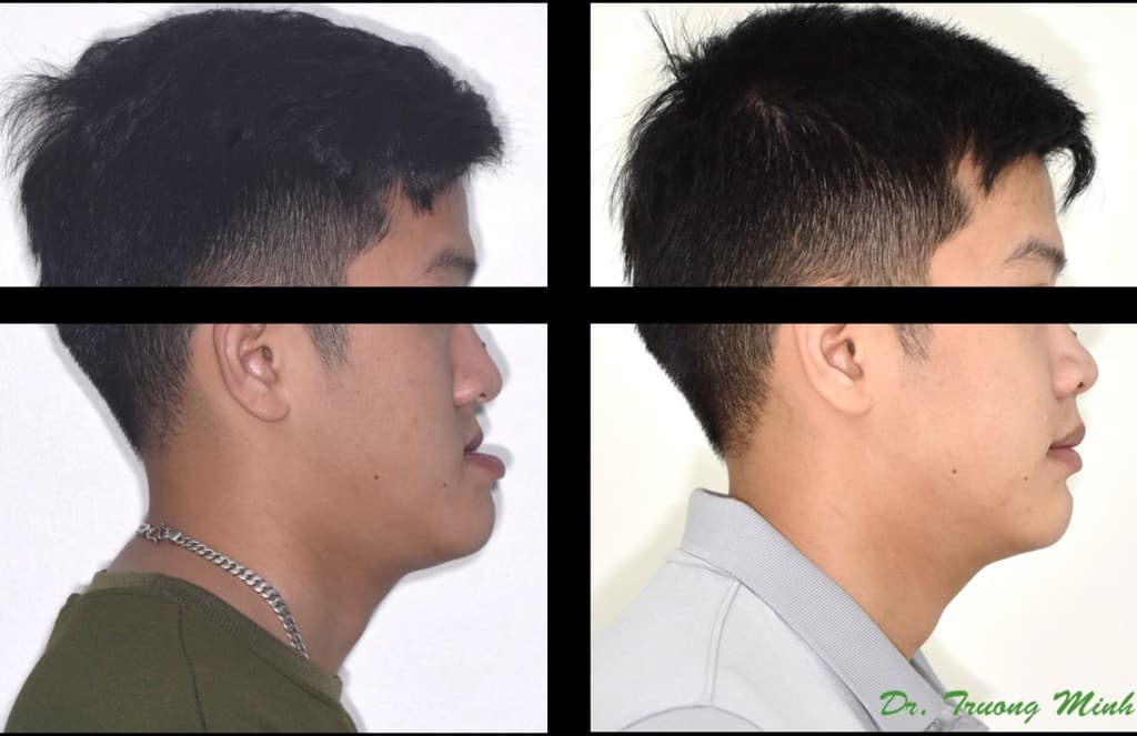 Before and after orthognathic jaw surgery male profile comparison