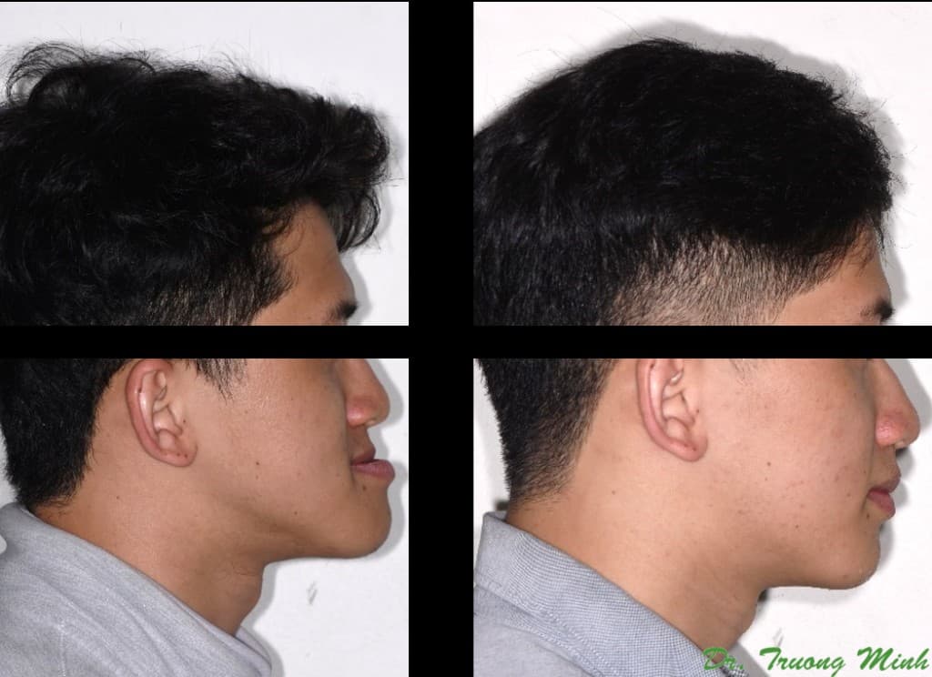 Male patient before and after jaw surgery profile