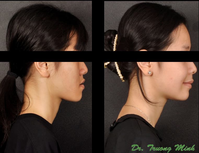 Before and after acne treatment and hairline profile comparison