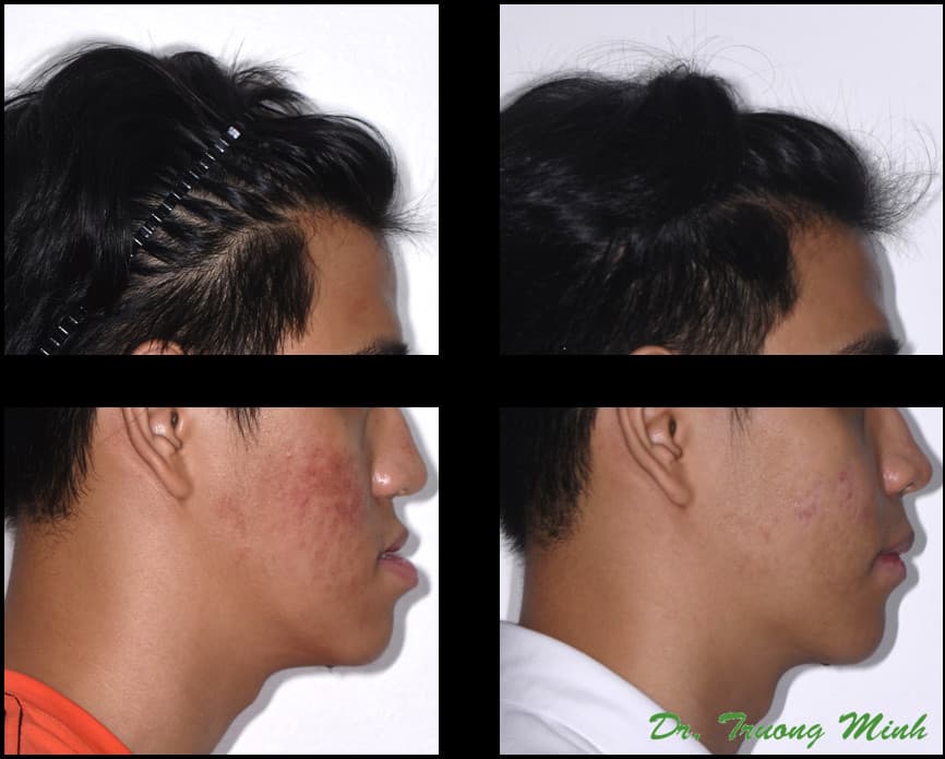 Before and after Class III jaw correction male profile