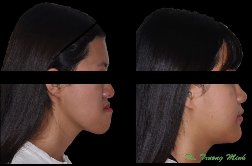 Female patient before and after jaw and orthodontic profile comparison